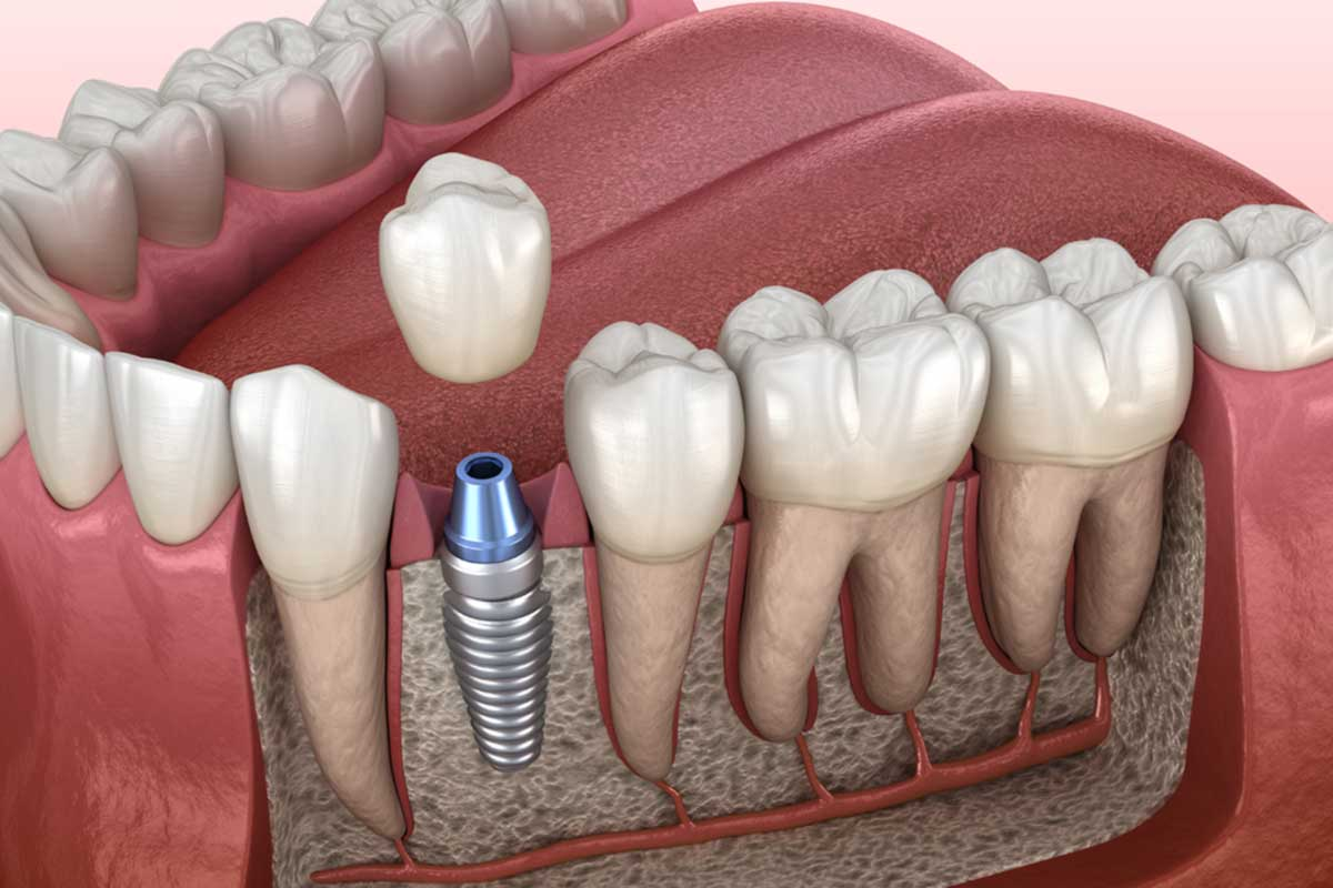 Chưa có nghiên cứu nào chứng minh trụ Implant ảnh hưởng đến các tế bào vị giác hay làm thay đổi chức năng cảm nhận vị giác của con người Chưa có nghiên cứu nào chứng minh trụ Implant ảnh hưởng đến các tế bào vị giác hay làm thay đổi chức năng cảm nhận vị giác của con người